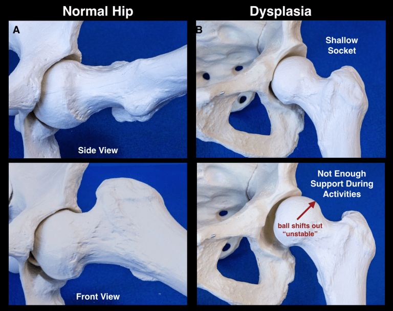 normal hip seiries xrays