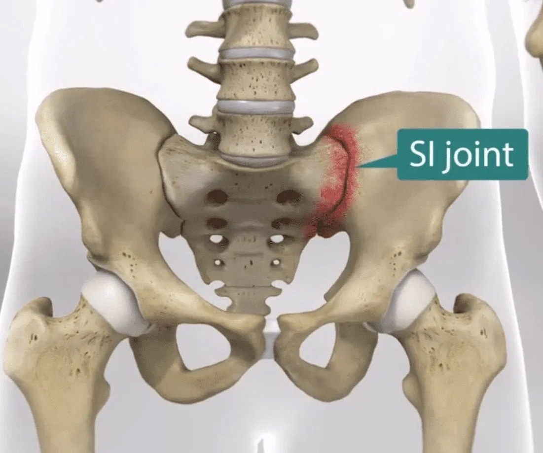SI Joint Problems And Treatment  Los Angeles, Beverly Hills, Santa Monica  CA