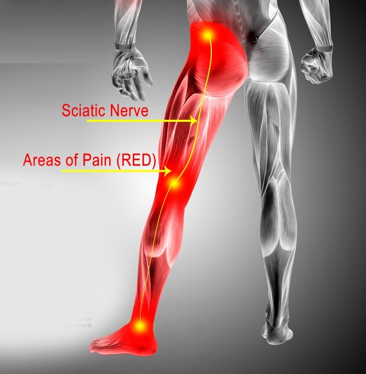 That Hip Pain Could Actually Be a Sciatica Problem - Physical Therapists NYC